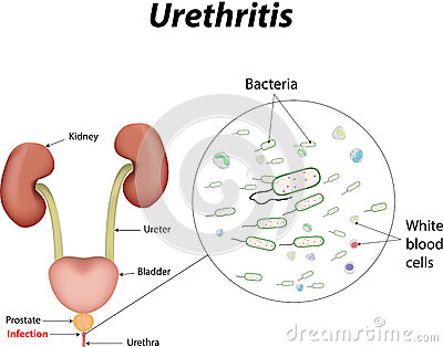 urethritis bacterial urethra inflamed reproductive